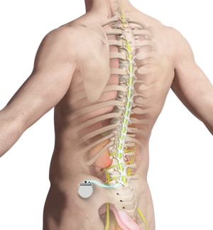 Why Do I Need Psychological Screening for Spinal Cord Stimulation?